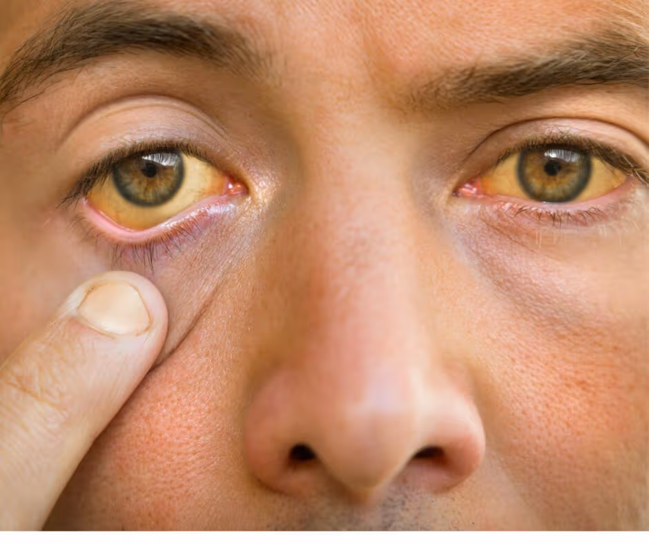 Common Health Conditions Caused by Chronic Alcohol Abuse